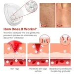 DermaSmooth Skin Tag Remover Patch |  Fast, Safe & Painless Skin Tag & Mole Removal | Nano-Microneedle Technology | 72 Patches - Image 4